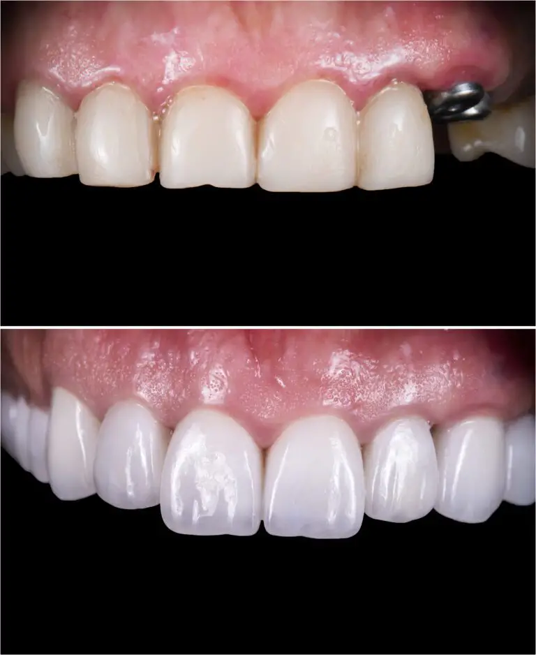 Dentist_In_North_Hollywood_dentist-north-Dental_implants