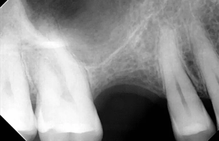 Dentist_In_North_Hollywood_sinus-lift_dental_implants_img1