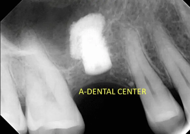 Dentist_In_North_Hollywood_sinus-lift_dental_implants_img2