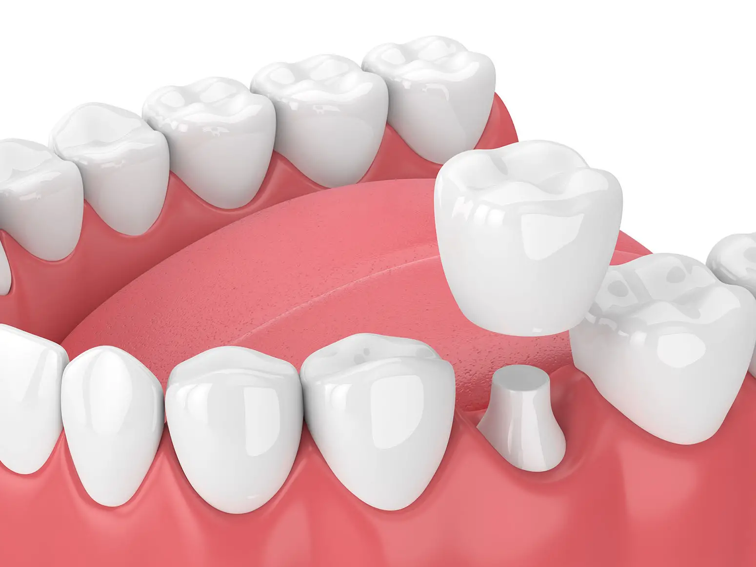 North_Hollywood_CA_Dental_crowns1