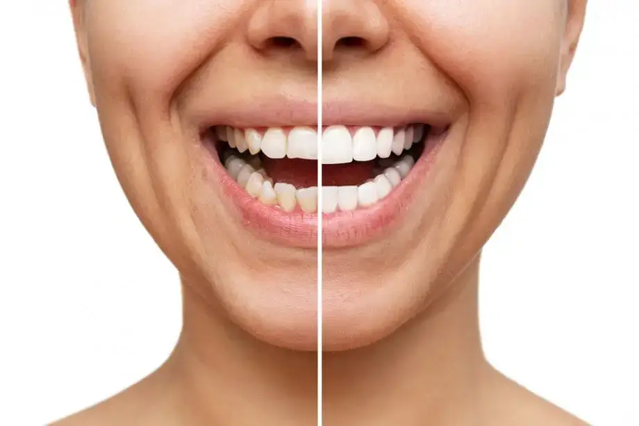 North_Hollywood_CA_veeners