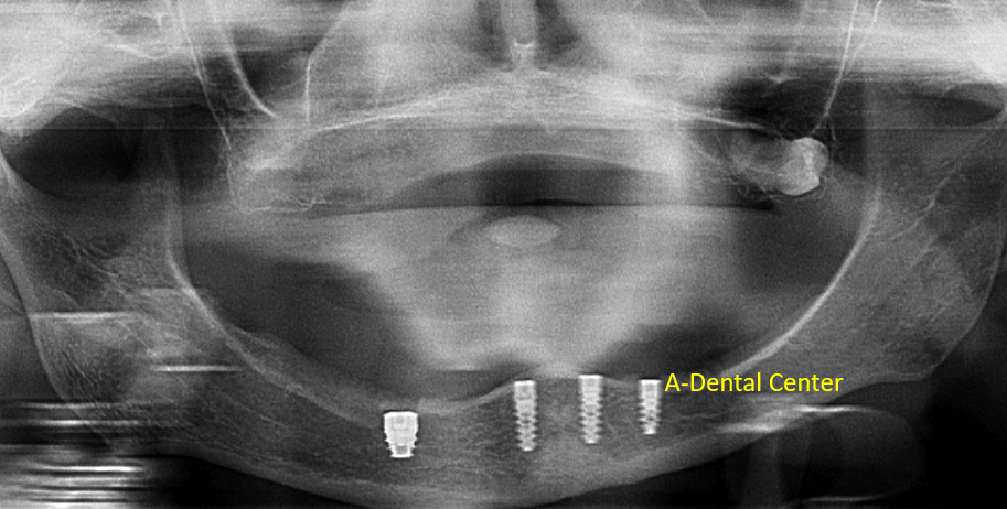 All-On-4 Image 5 (1)