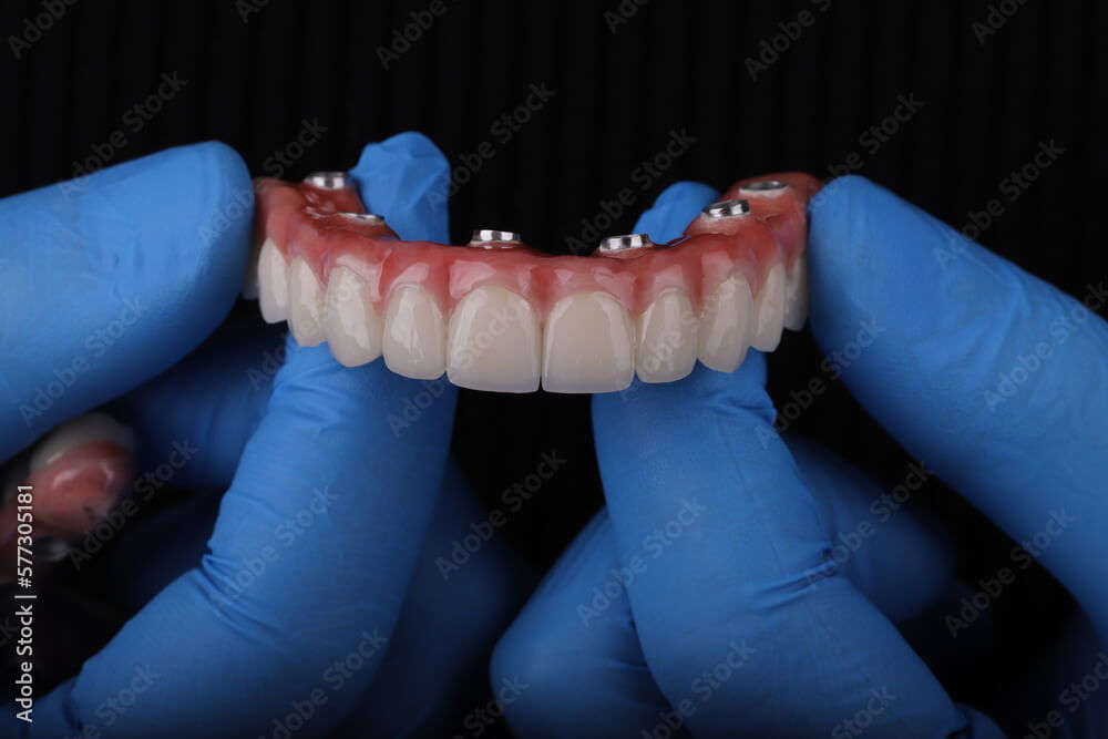 All-On-4 Image 6 (1)