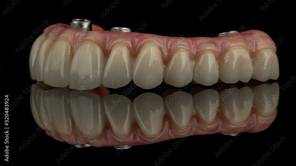 All-On-4 Image 7 (1)