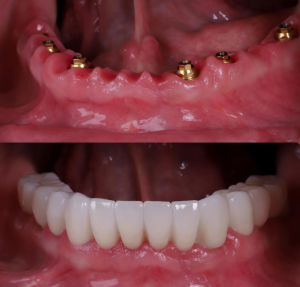 All-on-4 recovery North Hollywood — patient resting after dental implant surgery at A-Dental Center