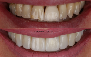 Cosmetic dentistry smile makeover best dentist North Hollywood — veneers whitening A-Dental