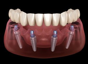 Full mouth restoration bridges and dental implants North Hollywood — A-Dental Center