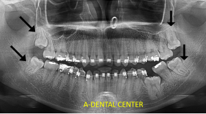 Dental X-rays North Hollywood — digital X-ray imaging at A-Dental Center