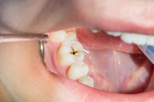 Early cavity enamel decay stage 1 North Hollywood — small filling A-Dental Center