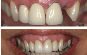 Full mouth restoration bridges and dental implants North Hollywood — A-Dental Center