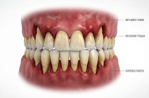 Gum recession bone loss progression North Hollywood — periodontal disease A-Dental Center