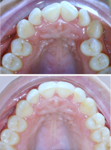 Invisalign before and after smile transformation North Hollywood — A-Dental Center aligners