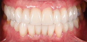 Are veneers permanent North Hollywood — porcelain veneers correcting crowding at A-Dental Center