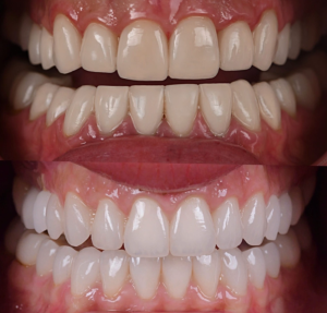 Replacing old composite veneers with porcelain veneers North Hollywood — A-Dental Center smile transformation