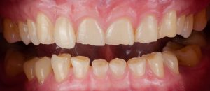 Worn flat enamel from teeth grinding bruxism North Hollywood — A-Dental Center